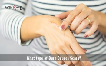 What type of Burn Causes Scars?
